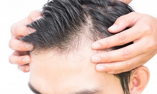 Types of Scalp Micropigmentation Procedures To Choose From